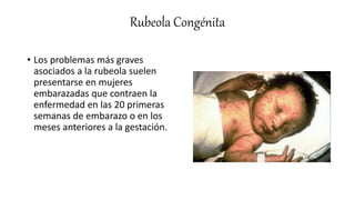 Fruth Rubeola Rubeola | PPTX