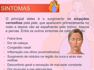 SINTOMAS
• Febre leve
• Dor de cabeça
• Congestão nasal
• Inflamação nos olhos (avermelhados)
• Surgimento de nódulos na região da nuca e atrás das
orelhas
• Desconforto geral e sensação de mal-estar constante
O principal deles é o surgimento de erupções
vermelhas pela pele, que aparecem primeiramente no
rosto e depois vão se espalhando pelo tronco, braços
e pernas. Entre os outros sintomas da rubéola estão:
 