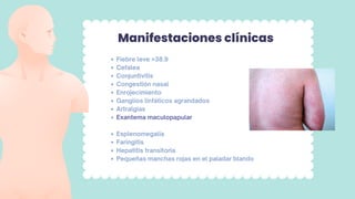 Manifestaciones clínicas
Fiebre leve >38.9
Cefalea
Conjuntivitis
Congestión nasal
Enrojecimiento
Ganglios linfáticos agrandados
Artralgias
Exantema maculopapular
Esplenomegalia
Faringitis
Hepatitis transitoria
Pequeñas manchas rojas en el paladar blando
 