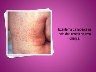 Exantema da rubéola na
pele das costas de uma
criança.
 