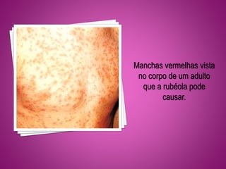 Manchas vermelhas vista
no corpo de um adulto
que a rubéola pode
causar.
 