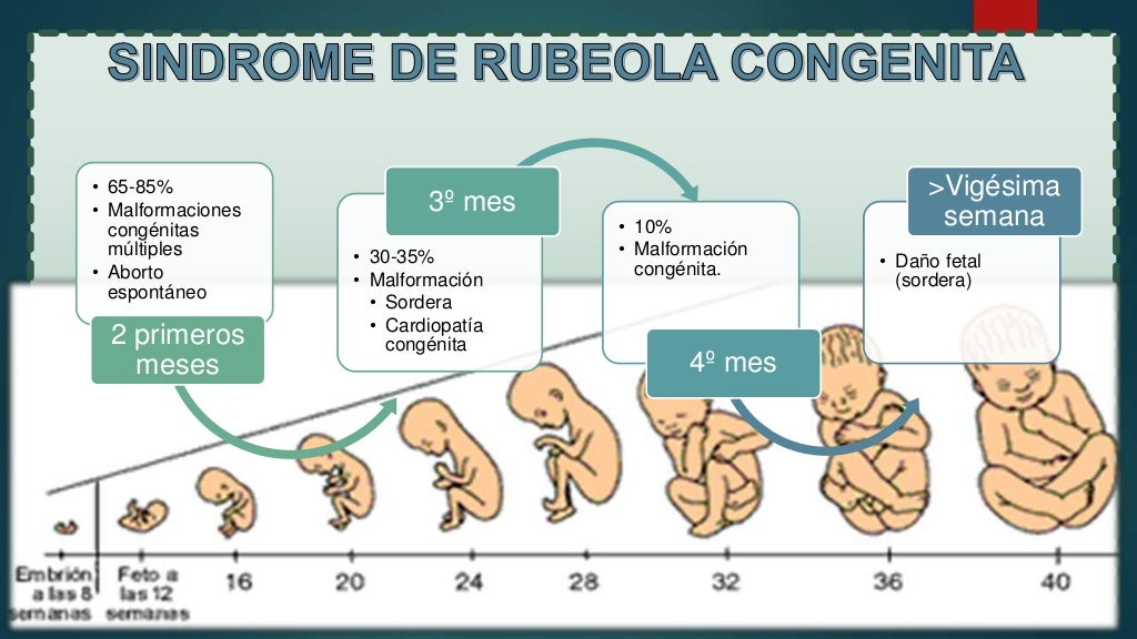 Rubéola