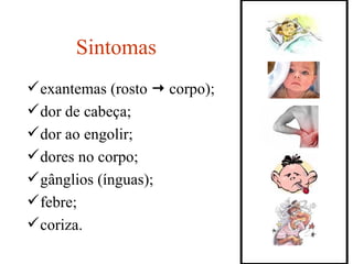 Sintomas exantemas (rosto    corpo); dor de cabeça; dor ao engolir; dores no corpo; gânglios (ínguas); febre; coriza. 