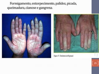 Formigamento,entorpecimento,palidez,picada,
queimadura,cianoseegangrena.
25
FRANCIELLEDEALMEIDA
ETECAntônioDevisateMarília-SP
SegurançaeMedicinadoTrabalho
 