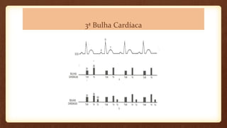 3ª Bulha Cardíaca
 