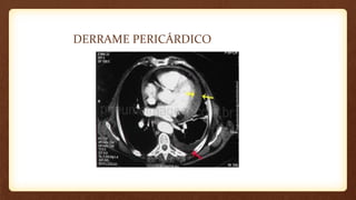 DERRAME PERICÁRDICO
 