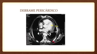 DERRAME PERICÁRDICO
 