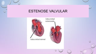 ESTENOSE VALVULAR
 