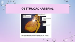 OBSTRUÇÃO ARTERIAL
 