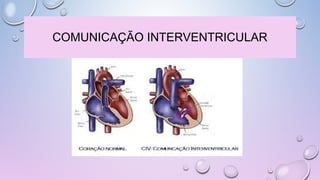 COMUNICAÇÃO INTERVENTRICULAR
 