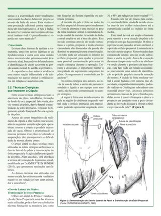 túnica e a extremidade transversalmente
seccionada do ducto deferente projete-se
através da linha de sutura. Esta técnica é
uma precaução adicional contra reanastomose do trato reprodutivo. A pele é fechada com 2 a 3 suturas interrompidas de material inabsorvível. O procedimento é repetido no outro testículo19.
• Vasectomia
Existem duas formas de realizar a vasectomia, uma com acesso idêntico ao da
Epididectomia e outra com uma incisão
única intertesticular próximo-caudal (vasectomia alta), buscando-se bilateralmente
a identificação do ducto deferente na porção caudo-medial do cordão espermático.
A experiência dos autores evidencia
uma maior reação inflamatória e de edemaciação no acesso similar à epididectoma em relação à vasectomia alta.
3.2. Técnicas Cirúrgicas
que impedem a Cópula
Entre essas técnicas cirúrgicas estão: a
aderência do pênis, retroflexão, formação
de fundo de saco prepucial, falectomia, desvio ventral de pênis, desvio lateral e translocação de óstio prepucial, remoção do ligamento apical e fixação de flexura sigmóide do pênis.
Apesar de serem impeditivas da realização da cópula, a elas podem estar associadas às seguintes complicações pós operatórias: retorno a cópula e prenhêz indesejada de vacas, fibrose e exteriorização de
mucosa peniana e/ou pênis (evoluindo à
amputação), dor pós-operatória e dificuldade de monta, dentre outras.
O artigo citará as duas técnicas mais
utilizadas na rotina cirúrgica de bovinos: o
desvio lateral do pênis e translocação do
óstio prepucial e fixação da flexura sigmóide do pênis. Além das duas, será abordada
a técnica de remoção do ligamento apical,
modificada por VANDESTEEN JÚNIOR
(2010), que apresentou resultados satisfatórios.
As demais técnicas são utilizadas em
menor escala, levando em conta resultados
negativos em relação ao bem estar animal,
dor e senciência8.
• Desvio Lateral do Pênis e
Translocação do óstio Prepucial
O Desvio Lateral do Pênis e Translocação do Óstio Prepucial é uma das técnicas
mais utilizadas, pois o desvio estabelecido
não traz limitações na monta ou dor, como

nas fixações de flexura sigmóide ou aderência peniana.
A incisão da pele é feita ao redor do
orifício prepucial distante aproximadamente 3 cm da abertura e uma incisão na pele
da linha mediana ventral é estendida na direção caudal da incisão. A incisão da linha
central amplia-se até a base do pênis. Esta
incisão continua através do tecido subcutâneo e o pênis, prepúcio e tecido elástico
circundante são dissecados da parede abdominal na preparação para a translocação.
Um tubo pode ser colocado no interior do
orifício prepucial, para ajudar a prevenir
uma possível contaminação pela urina da
região cirúrgica durante a operação. Durante a dissecção, é importante manter a
integridade do suprimento sanguíneo do
pênis. O sangramento é controlado por ligaduras19.
Na rotina cirúrgica dos autores, ao invés de uso de tubos, a uretra do paciente é
sondada e ligada a um equipo com soro
vazio, não havendo contaminação no campo cirúrgico.
A seguir é feita uma incisão circular da
pele na região do abdômen esquerdo ventral onde o orifício prepucial será translocado, podendo apresentar angulação entre

30 a 45% em relação ao óstio original2,15,19.
Usando um par de pinças para curativo, um túnel é feito vindo da incisão circular através dos tecidos subcutâneos até a
extremidade caudal da incisão de linha
media.
Este túnel deverá ser amplo o bastante
para permitir a nova situação do pênis e do
prepúcio sem que haja restrição. O pênis e
o prepúcio são passados através do túnel, e
a pele do orifício prepucial é suturada até a
incisão circular da pele. São colocadas duas
camadas de suturas: uma no tecido subcutâneo e outra na pele. Antes da execução
da sutura é importante verificar se não houve torção durante o processo de translocação. Este fato pode ser evitado colocandose previamente uma sutura de identificação na pele do prepúcio antes da remoção
do mesmo. A incisão de linha mediana ventral é então fechada com suturas não absorvíveis, em padrão interrompido, podendo realizar-se Cushing no subcutâneo com
material absorvível. Animais zebuínos
apresentam excesso de pele e bainha pendular, assim é possível transpor o pênis e o
prepúcio em conjunto com a pele circundante ao invés de dissecar e liberar o pênis
e o prepúcio da pele19. (Figura 2)

Orifício
prepucial
Incisões da pele

Tubo no interior
do prepúcio
Sutura de identificação
Pênis e prepúcio

Túnel subcutâneo
Figura 2: Demonstração do Desvio Lateral de Pênis e Translocação de Óstio Prepucial
(Fonte: TURNER& McILWRAITH,1985)

 