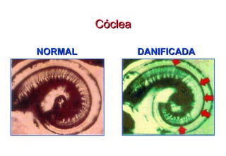 Cóclea NORMAL DANIFICADA 