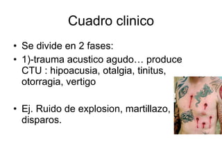 Cuadro clinico Se divide en 2 fases: 1)-trauma acustico agudo… produce  CTU : hipoacusia, otalgia, tinitus, otorragia, vertigo Ej. Ruido de explosion, martillazo, disparos. 