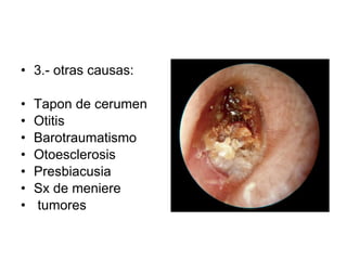 3.- otras causas: Tapon de cerumen Otitis Barotraumatismo Otoesclerosis Presbiacusia Sx de meniere tumores 