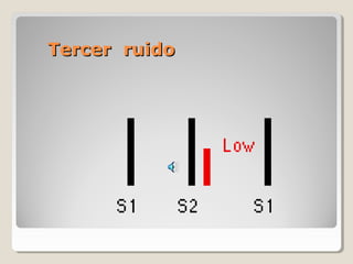 Tercer ruido
 