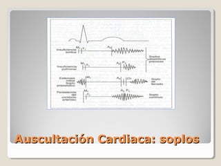 Auscultación Cardiaca: soplos
 