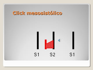 Click mesosistólico
 
