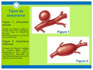 Tipos de
aneurisma
Figura 1: Aneurisma
sacular.
(Tomado de: Raupp E. [página en
Internet] Brasil. C2011. [actualizado
en 2011; citado el 17/May/2013].
Disponible en
http://dreduardoraupp.com.br/tratame
nto_aneurisma.php)
Figura 2: Aneurisma
fusiforme
(Tomado de: Raupp E. [página
en Internet] Brasil. C2011.
[actualizado en 2011; citado el
17/May/2013]. Disponible en
http://dreduardoraupp.com.br/tra
tamento_aneurisma.php)
Figura 2
 