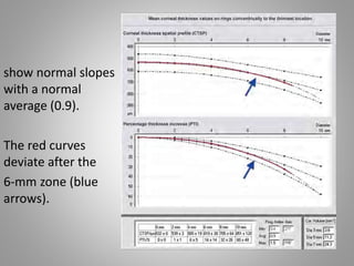 Normal Crown Slopes Rules in refractive surgery | PPTX