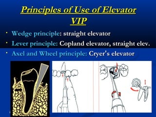 Rules of using dental forceps & elevator | PPT