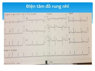 Điện tâm đồ rung nhĩ
 