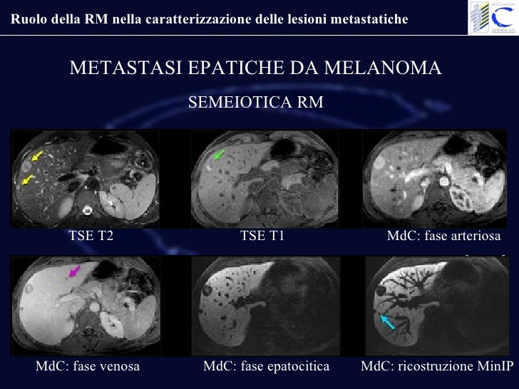 Sodani Giulio Ruolo Della Rm Nella Caratterizzazione Delle