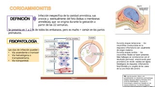 Funisitis RUPTURA PREMATURA DE MEMBRANAS Y CORIOAMNIONITIS.pptx
