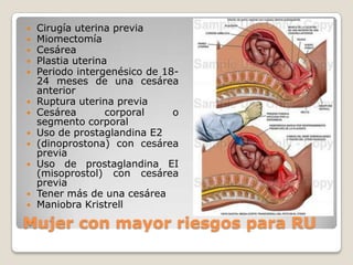 Mujer con mayor riesgos para RU
 Cirugía uterina previa
 Miomectomía
 Cesárea
 Plastia uterina
 Periodo intergenésico de 18-
24 meses de una cesárea
anterior
 Ruptura uterina previa
 Cesárea corporal o
segmento corporal
 Uso de prostaglandina E2
 (dinoprostona) con cesárea
previa
 Uso de prostaglandina EI
(misoprostol) con cesárea
previa
 Tener más de una cesárea
 Maniobra Kristrell
 