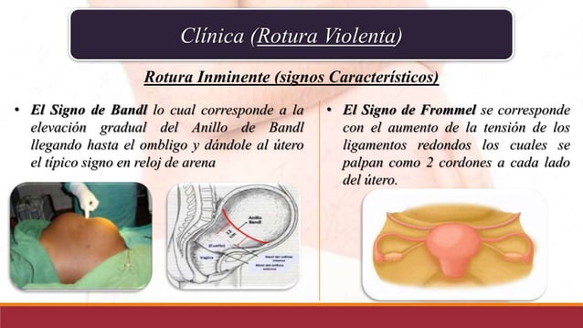 Ruptura uterina y ruptura de vasa previa
