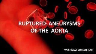 RUPTURED ANEURYSMS
OF THE AORTA
VAISHNAVI SURESH NAIR
 