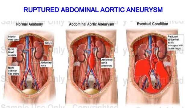what causes an aortic aneurysm to rupture