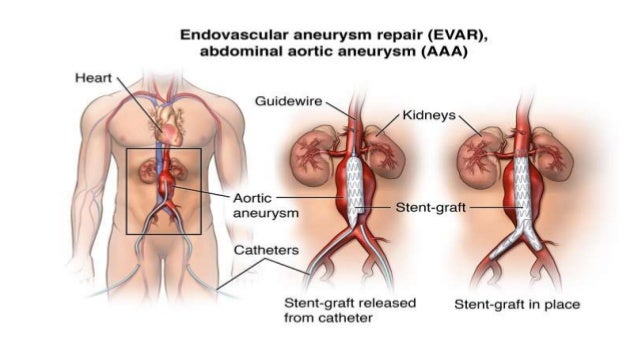 what causes an aortic aneurysm to rupture