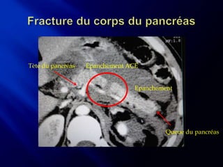 Tète du pancréas   Epanchement ACE


                                 Epanchement




                                          Queue du pancréas
 