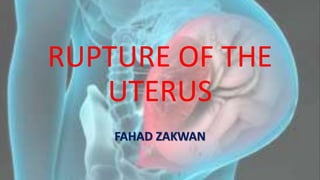RUPTURE OF THE
UTERUS
FAHAD ZAKWAN
 