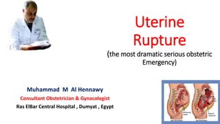 Uterine
Rupture
(the most dramatic serious obstetric
Emergency)
Muhammad M Al Hennawy
Consultant Obstetrician & Gynacologist
Ras ElBar Central Hospital , Dumyat , Egypt
 