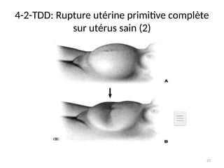 21
4-2-TDD: Rupture utérine primitive complète
sur utérus sain (2)
 