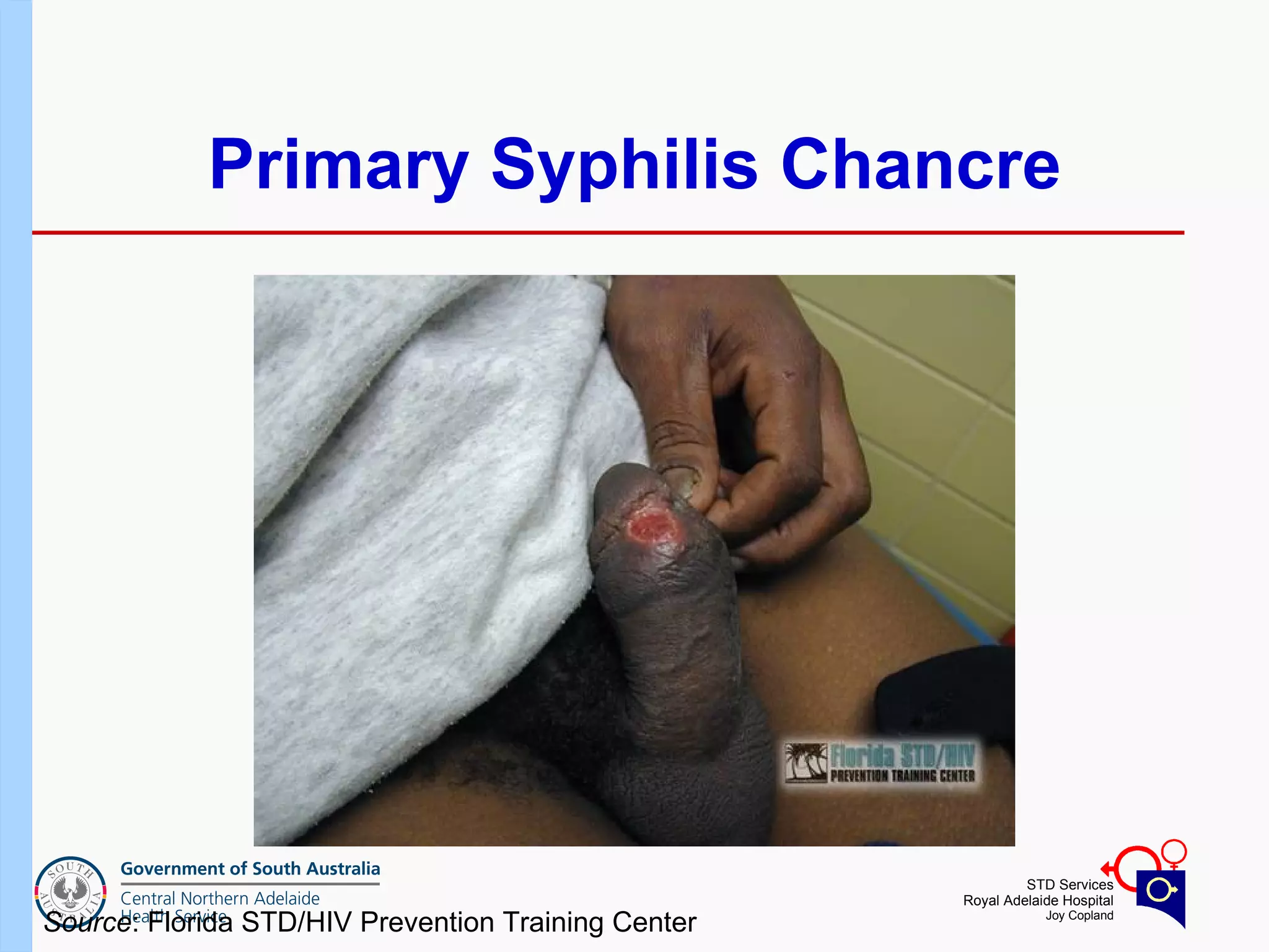 Primary Syphilis Chancre Source : Florida STD/HIV Prevention Training Center  