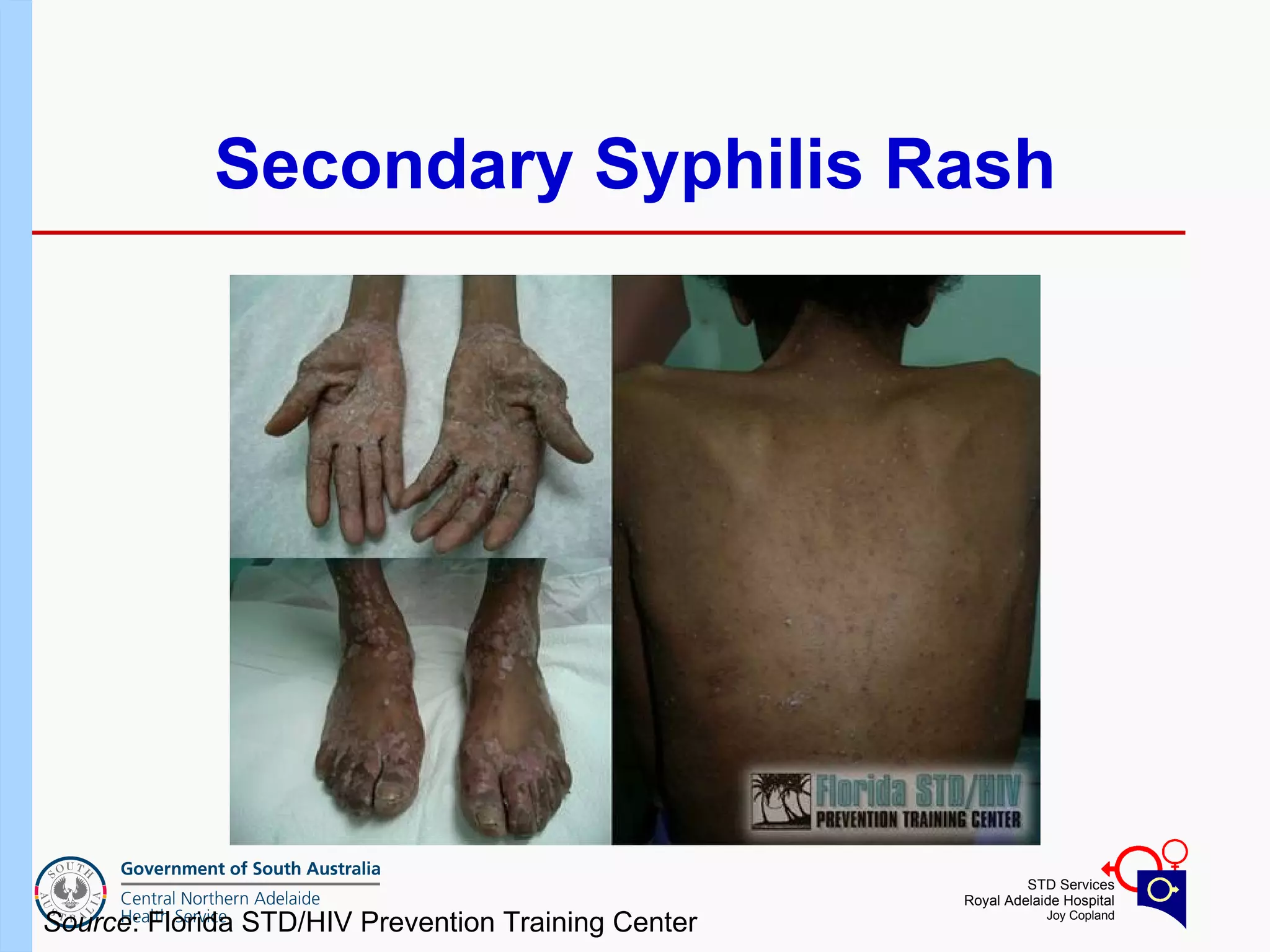 Secondary Syphilis Rash Source : Florida STD/HIV Prevention Training Center 