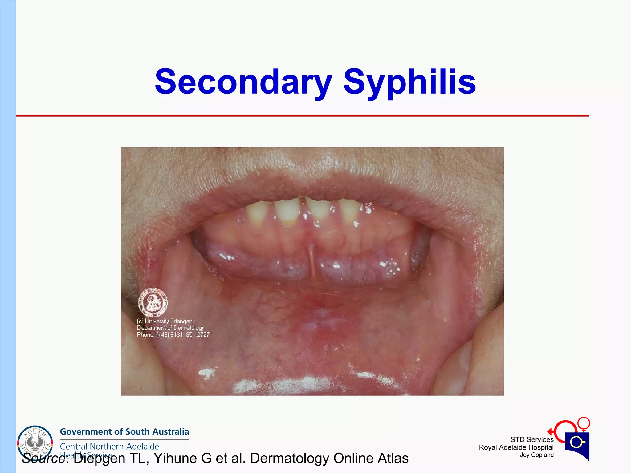 Secondary Syphilis Source : Diepgen TL, Yihune G et al. Dermatology Online Atlas  