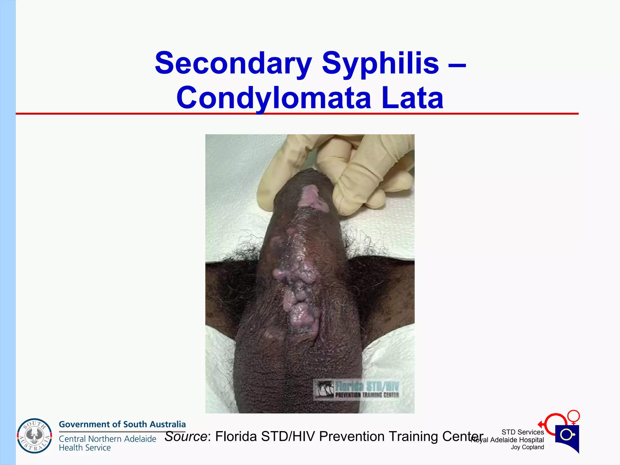Secondary Syphilis – Condylomata Lata Source : Florida STD/HIV Prevention Training Center 