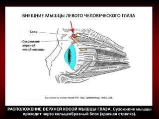 РАСПОЛОЖЕНИЕ ВЕРХНЕЙ КОСОЙ МЫШЦЫ ГЛАЗА. Сухожилие мышцы
проходит через кольцеобразный блок (красная стрелка).
 
