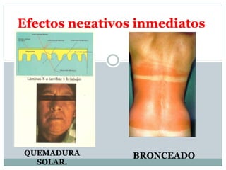 Efectos negativos inmediatosQUEMADURA SOLAR.BRONCEADO