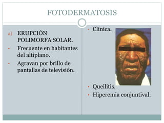 FOTODERMATOSISERUPCIÓN POLIMORFA SOLAR.Frecuente en habitantes del altiplano.