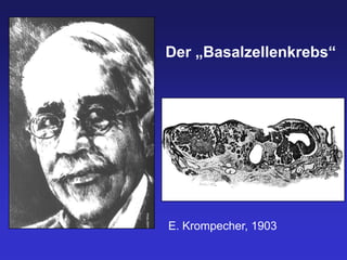 Der „Basalzellenkrebs“




E. Krompecher, 1903
 