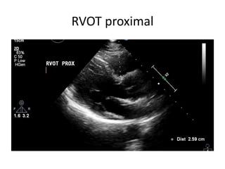 Rv assessment | PPTX