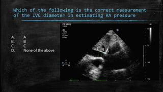 Which of the following is the correct measurement
of the IVC diameter in estimating RA pressure
A. A
B. B
C. C
D. None of the above ABC
 