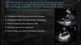 The end-systolic and end-diastolic parasternal short-
axis views of a 75-year-old patient are shown. Which of
the following statements is more likely to be true?
A.This patient likely has carcinoid heart disease.
B.This patient likely has Eisenmenger physiology.
C.There is evidence of a restrictiveVSD.
D. Pulmonic stenosis is suspected.
E.These images are classic for Ebstein anomaly
 