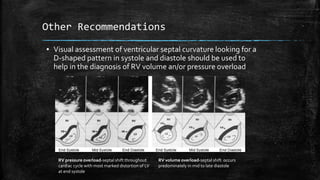 Other Recommendations
▪ Visual assessment of ventricular septal curvature looking for a
D-shaped pattern in systole and diastole should be used to
help in the diagnosis of RV volume an/or pressure overload
RV pressure overload-septal shift throughout
cardiac cycle with most marked distortion of LV
at end systole
RV volume overload-septal shift occurs
predominately in mid to late diastole
 