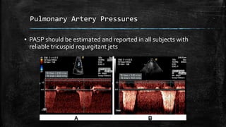 Pulmonary Artery Pressures
▪ PASP should be estimated and reported in all subjects with
reliable tricuspid regurgitant jets
 
