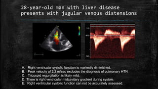 28-year-old man with liver disease
presents with jugular venous distensions
A. Right ventricular systolic function is markedly diminished.
B. Peak velocity of 2.2 m/sec excludes the diagnosis of pulmonary HTN
C. Tricuspid regurgitation is likely mild.
D. There is right ventricular midcavitary gradient during systole.
E. Right ventricular systolic function can not be accurately assessed.
 